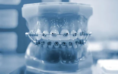 ¿Qué es mejor: brackets metálicos u ortodoncia invisible?