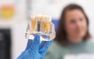 Implantes Dentales: Recupera tu Sonrisa y Salud Bucal